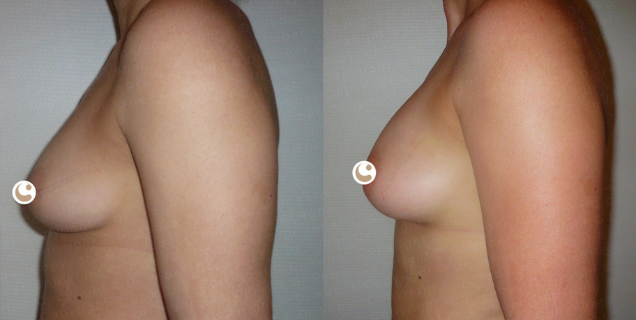 Breast lipofilling Geneva