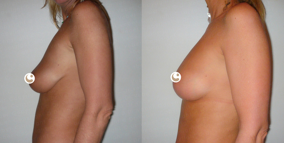 Breast lipofilling in Geneva
