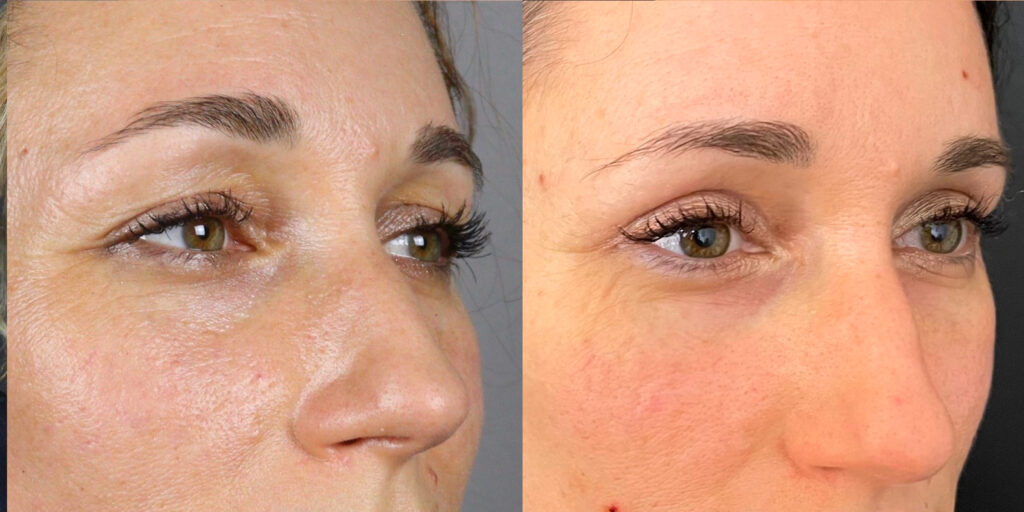 Capital Care Prestation Blepharoplastie Avant Apres 3