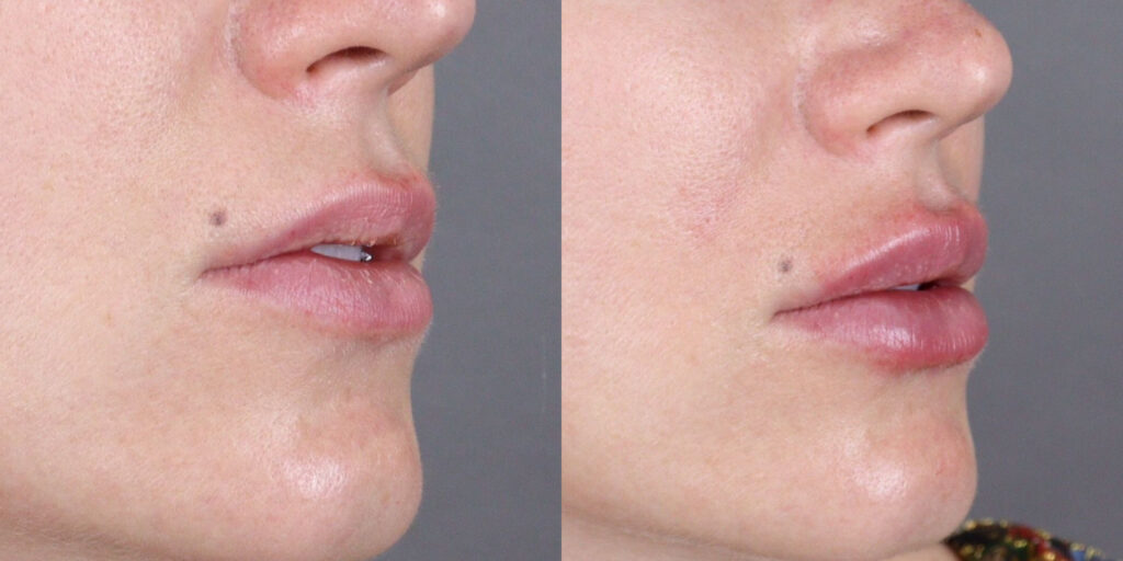 Capital Care Prestation Botulique Before After 1