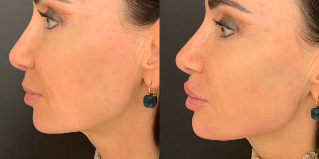 Capital Care Prestation Botulique Homme Before After 2