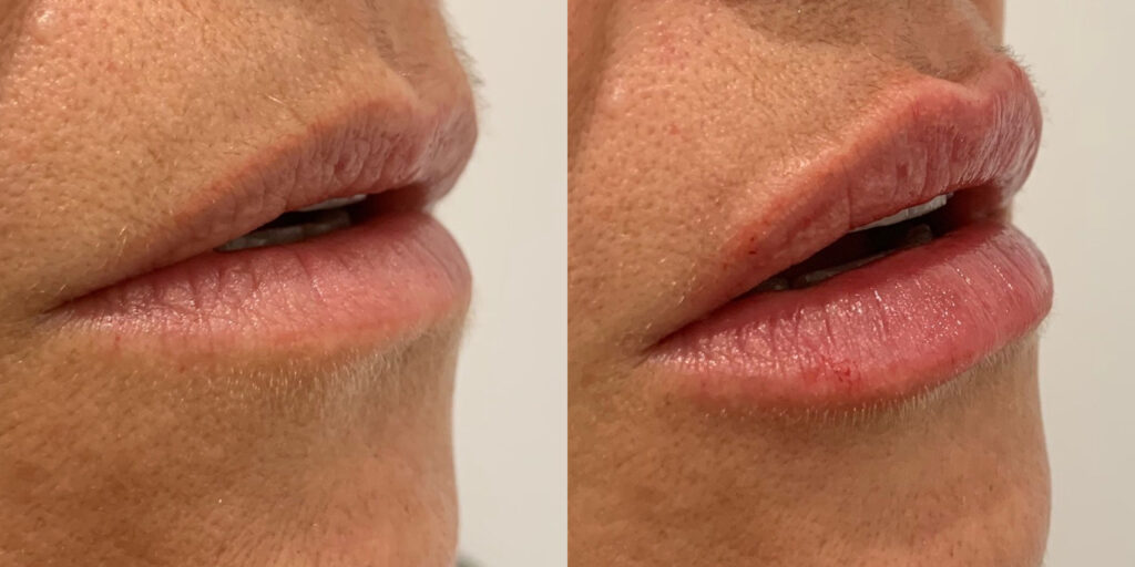 Capital Care - injection acide hyaluronique Genève