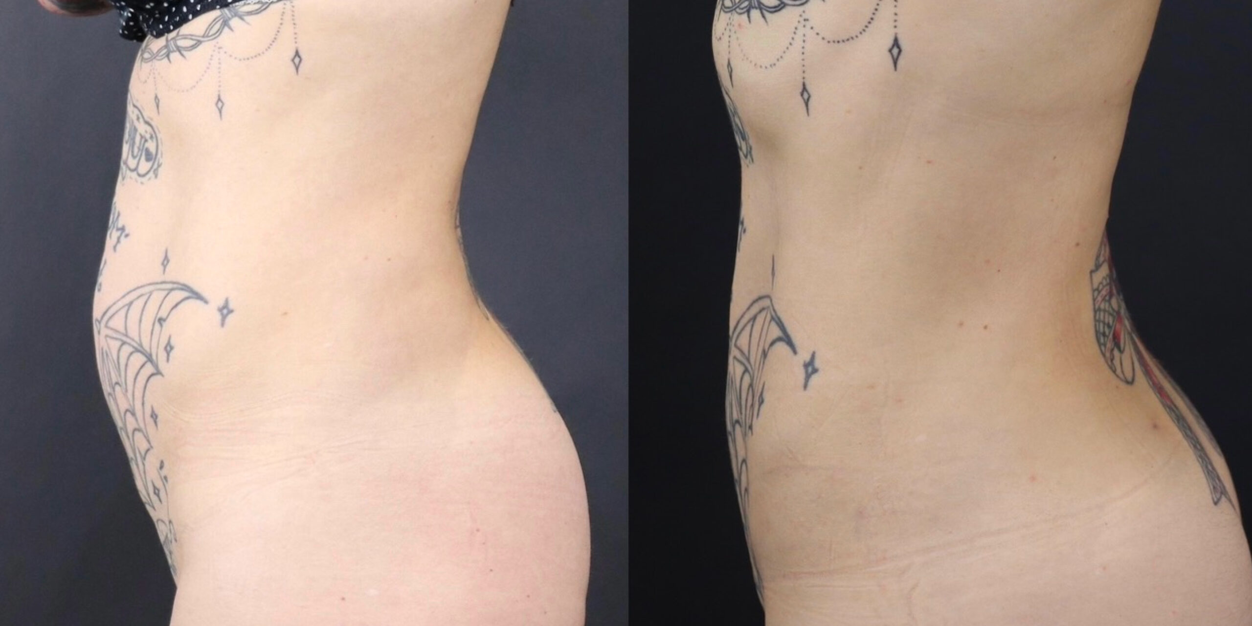 Lipoaspiration - Clinique chirurgie esthétique Genève  