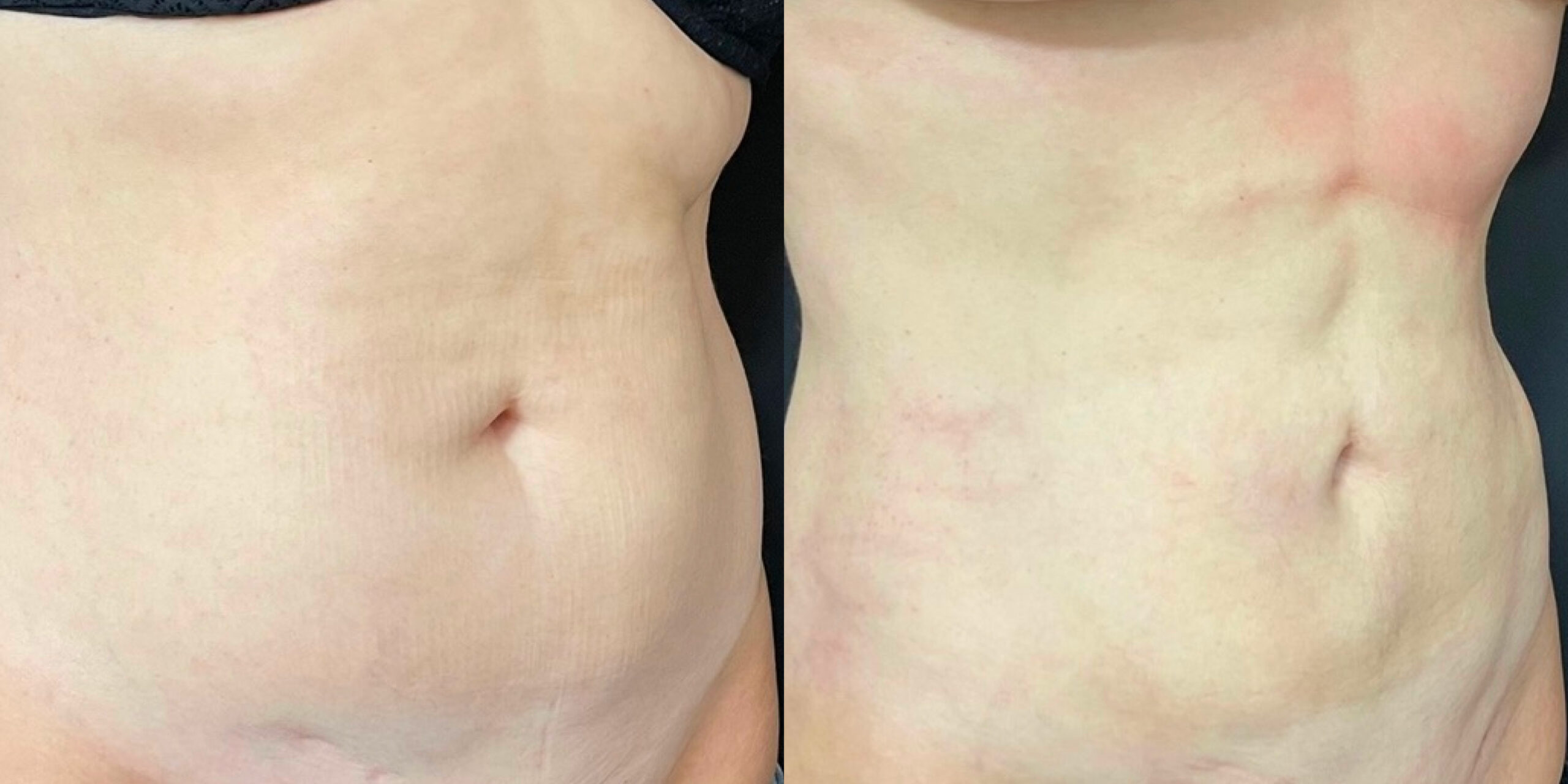 liposuction weight gain Geneva