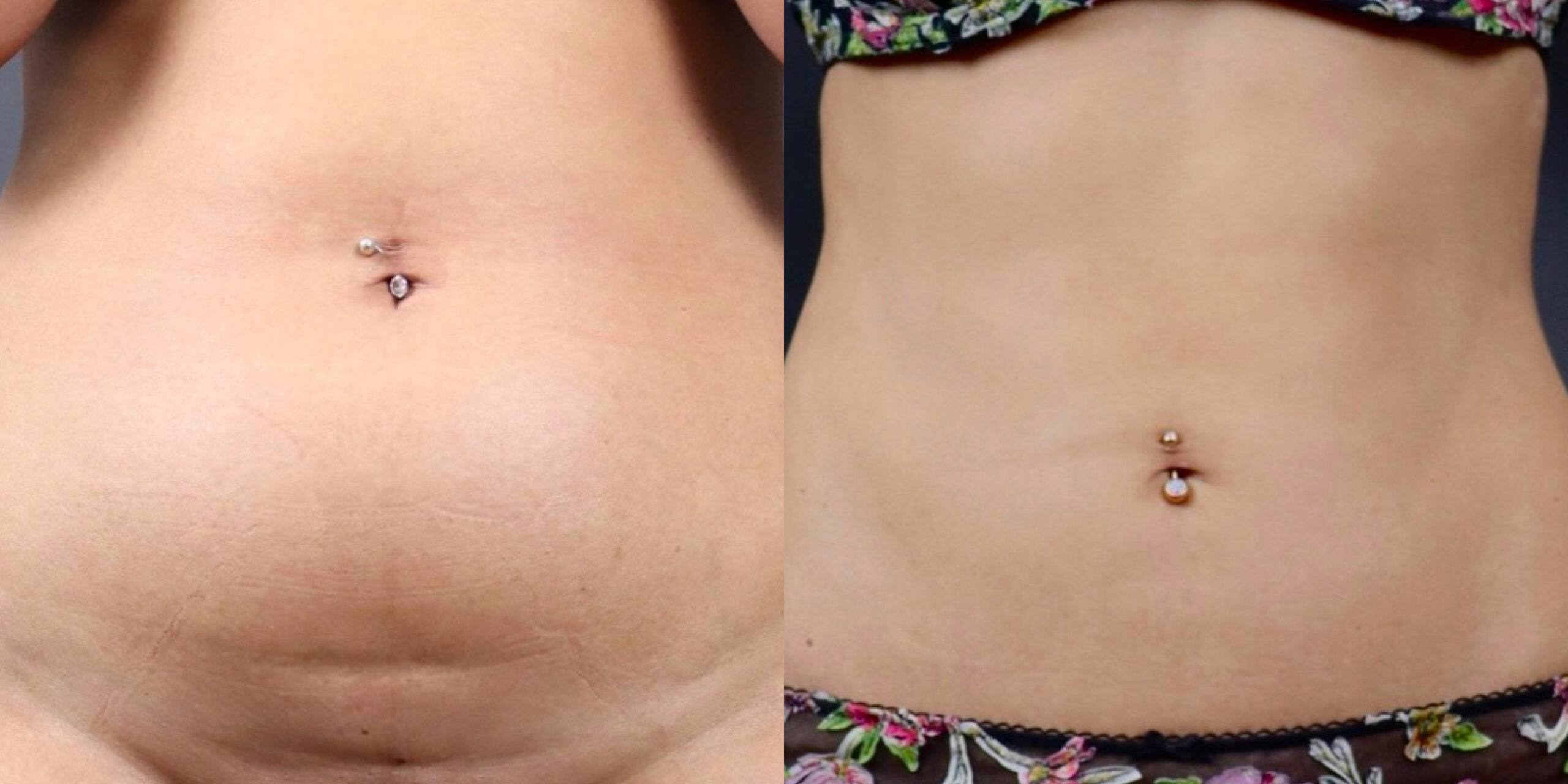 Fat cells - liposuction
