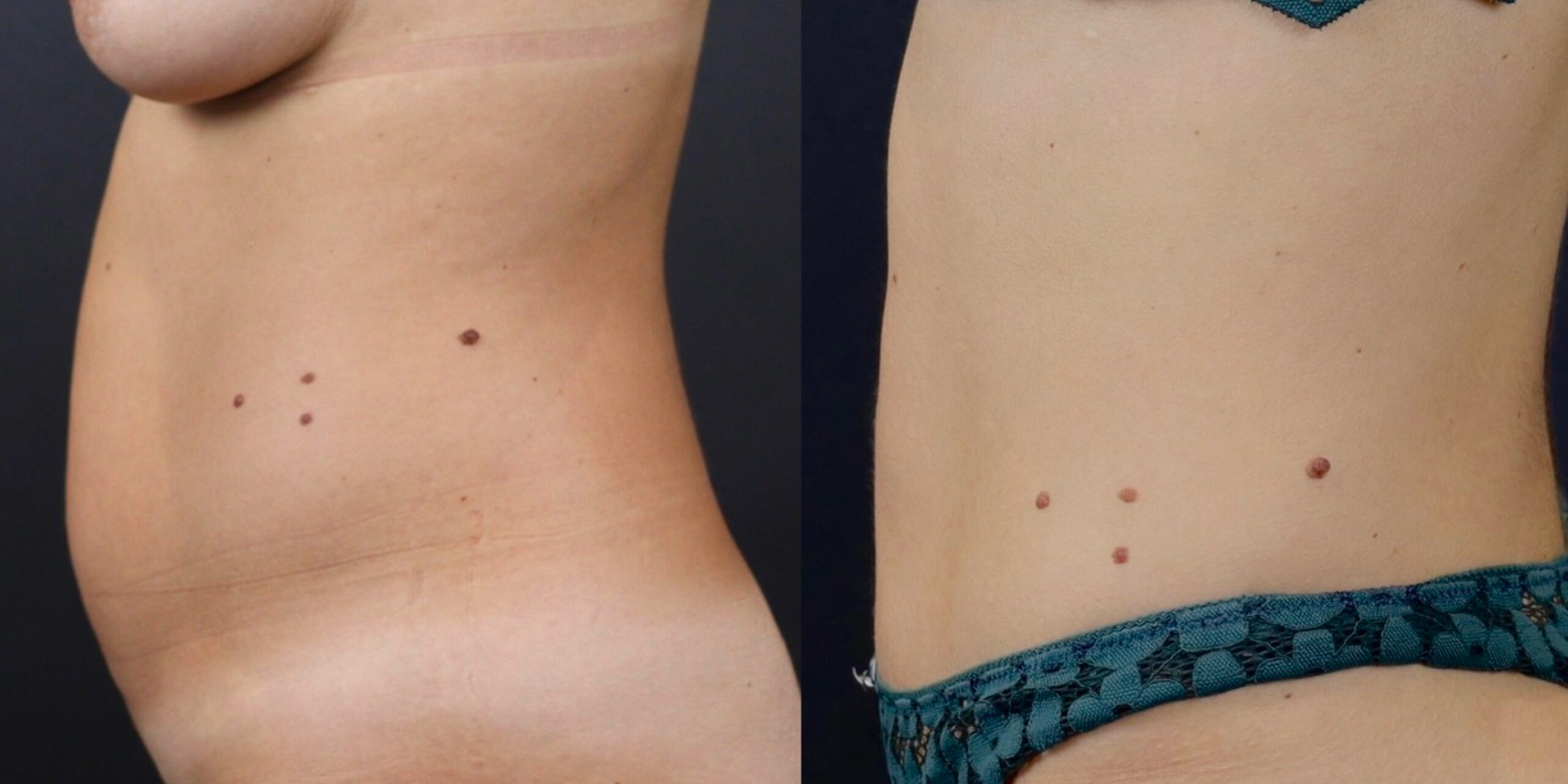 Liposuction liposuction  
